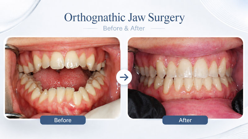 orthognathic jaw surgery before an after Houston Kanaan