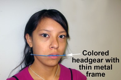 Headgear for overbite correction