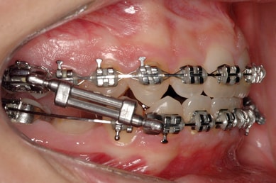 Correct overbite with twin force