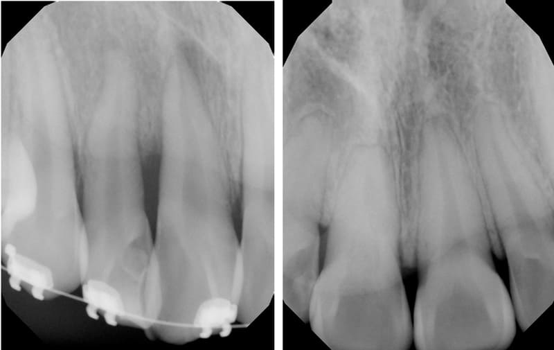 Long-term dental X-ray comparison showing the successful healing and stability of a replanted upper incisor six years after initial treatment and orthodontic completion.