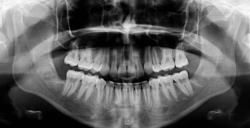 Final Xray
