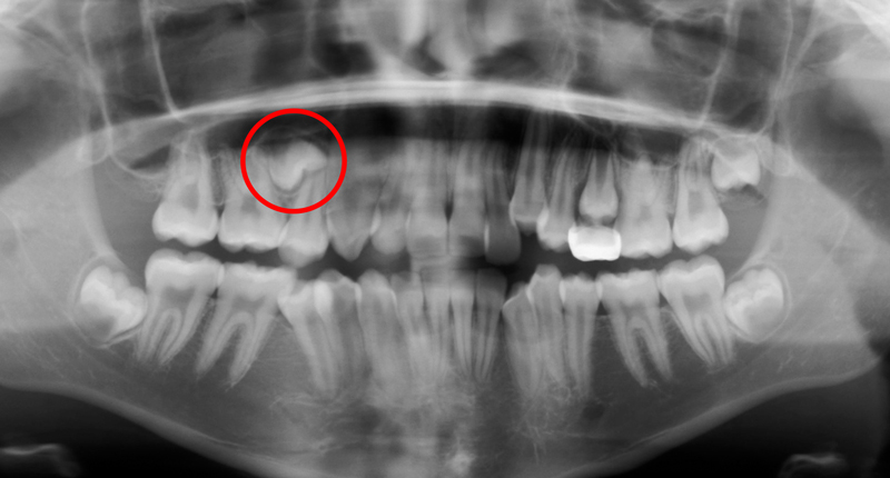 Crooked teeth Kanaan orthodontist sugarland