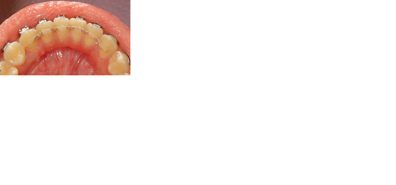 Permanent Retainer in Houston