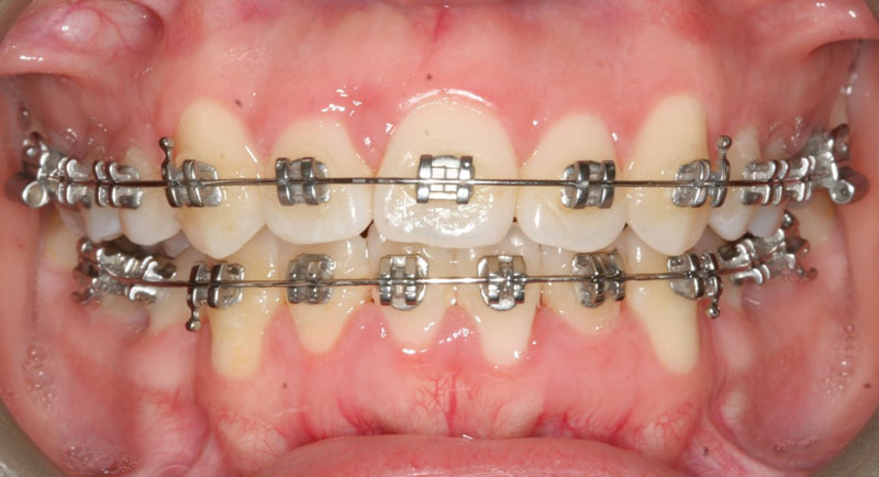 upper incisor extraction orthodontic case