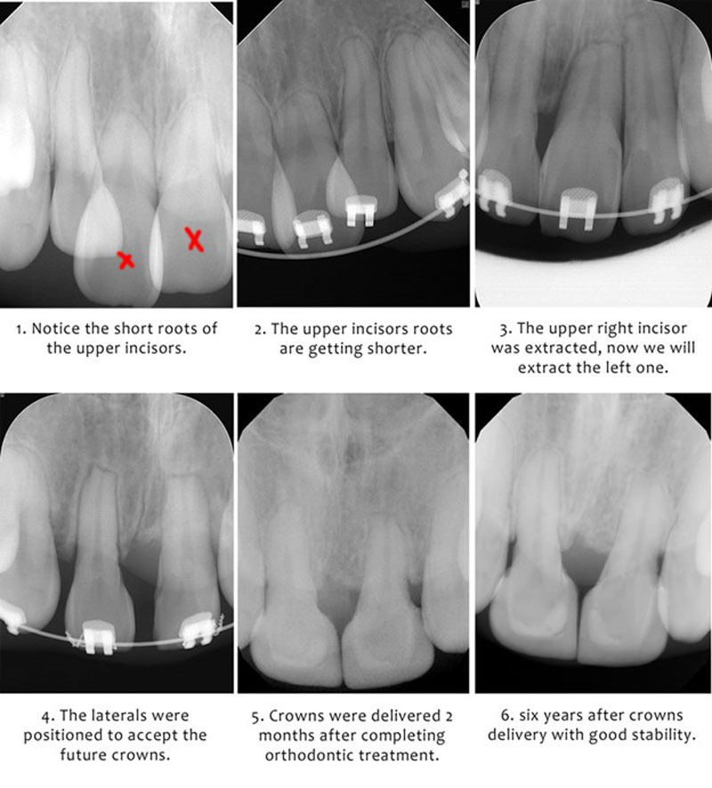 upper incisor extraction orthodontic case