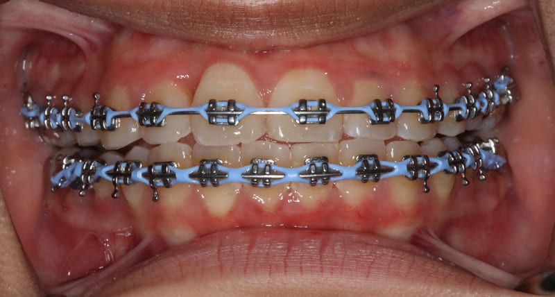 A progress photograph of a patient undergoing orthodontic treatment, showing metal braces with light blue power chains on both upper and lower arches to correct alignment and close dental gaps.