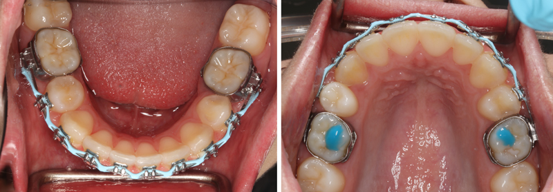 Progress orthodontic picture