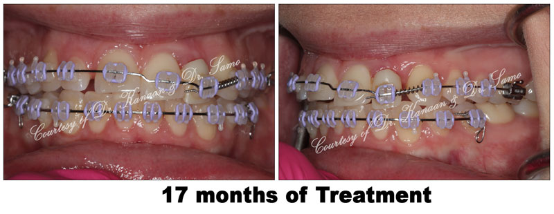 Orthodontic midline correction 