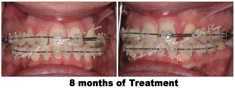 Orthodontic midline correction 