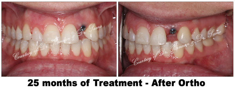 Orthodontic midline correction 