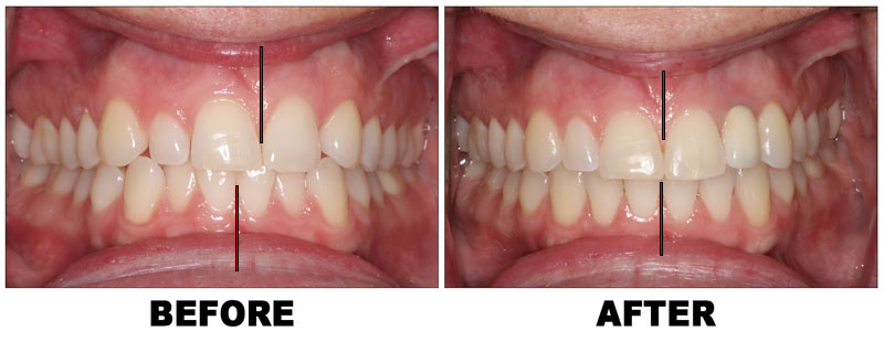 Specialists Collaborate for Extreme Orthodontic Case