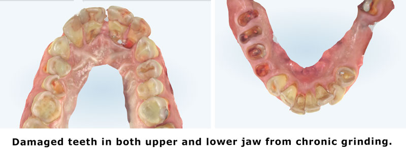 damaged teeth from Grinding Night guard cost in Houston