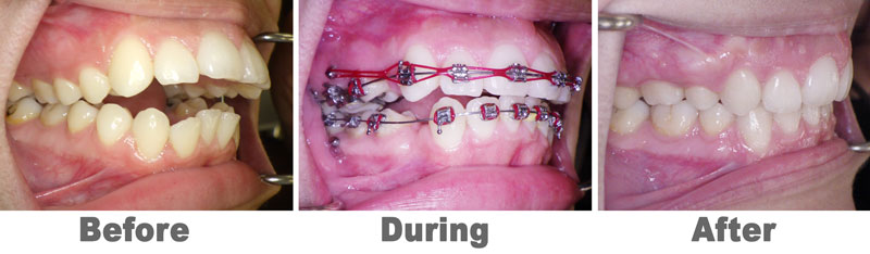 TADs used during severe anterior open bite case study with orthodontic extractions.