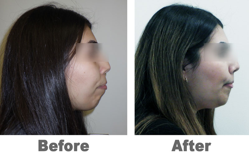 before and After for full profile open bite correction