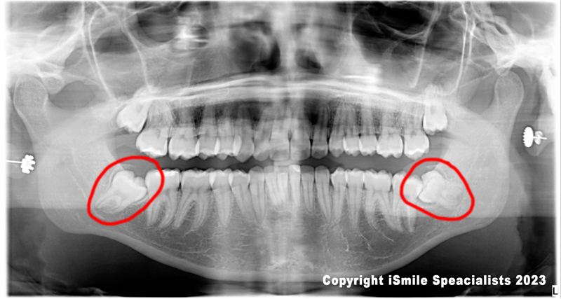 wisdom teeth case number 1