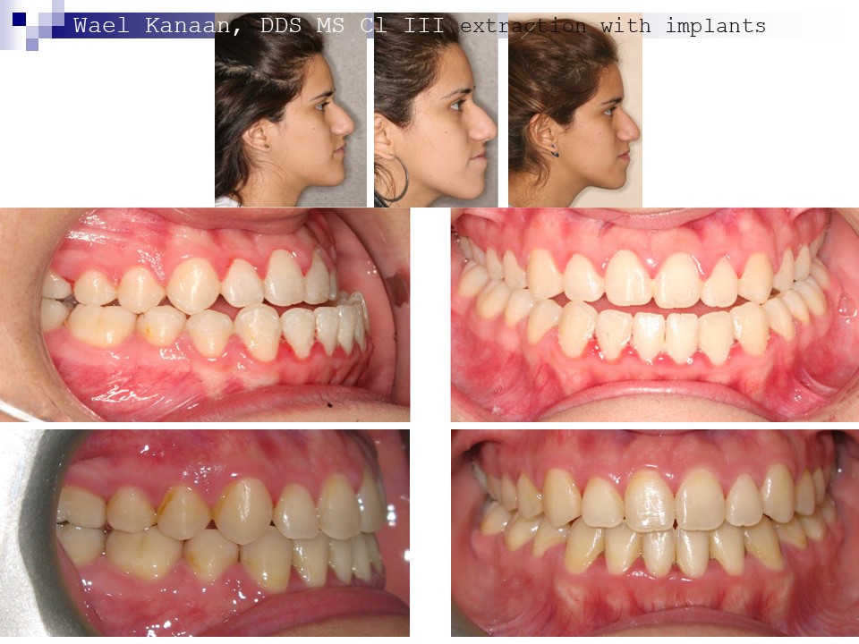 Underbite Correction Without Surgery