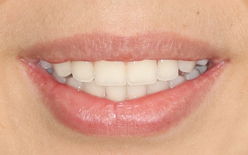 Excellent smile Sugar land orthodontist