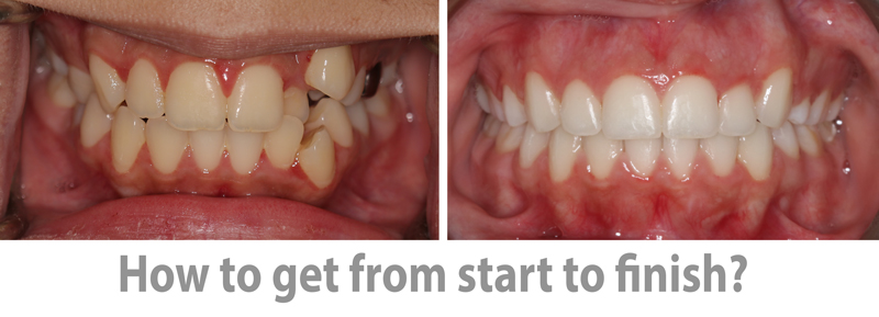 Crooke teeth Kanaan orthodontist sugarland