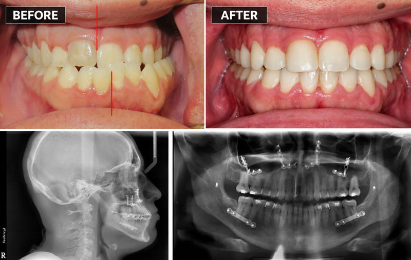 Surgical Midline correction