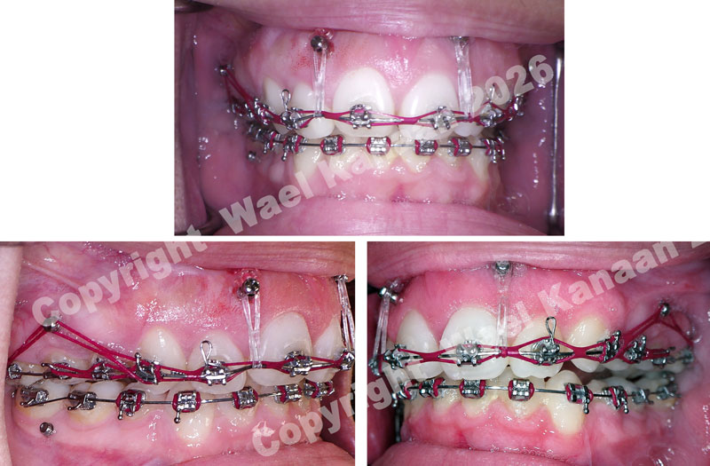 Open bite correction with TADs houston