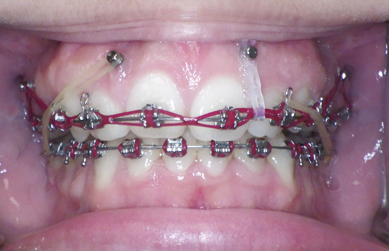 Open bite correction with TADs houston