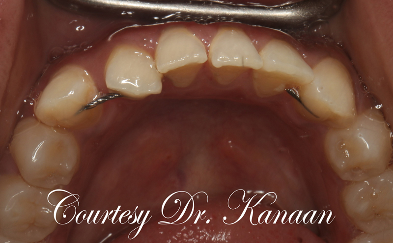 Teeth Shift with permanent retainer