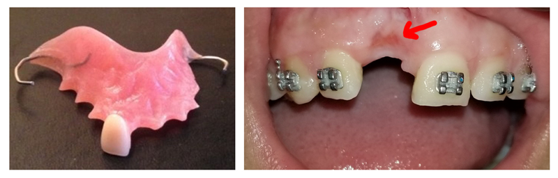 Bone loss from missing tooth
