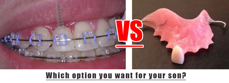 front tooth flipper Temporary dental implants