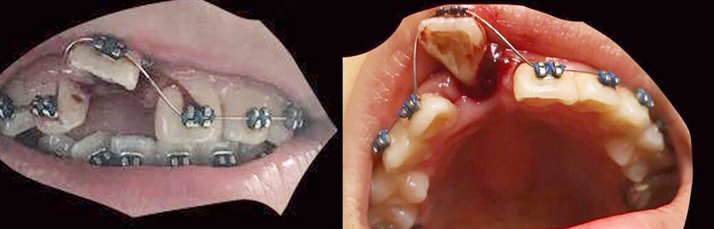 Trauma to front tooth