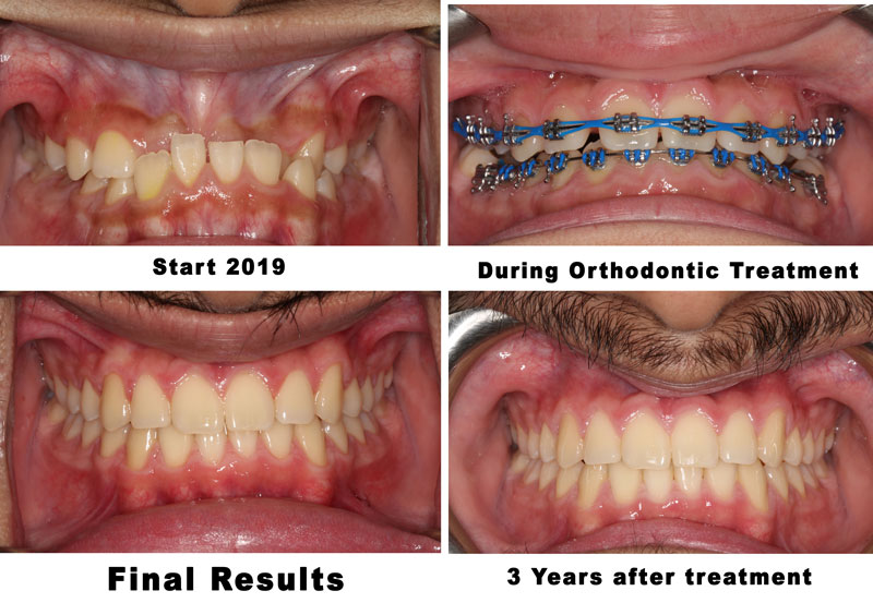 underbite correction in sugar land