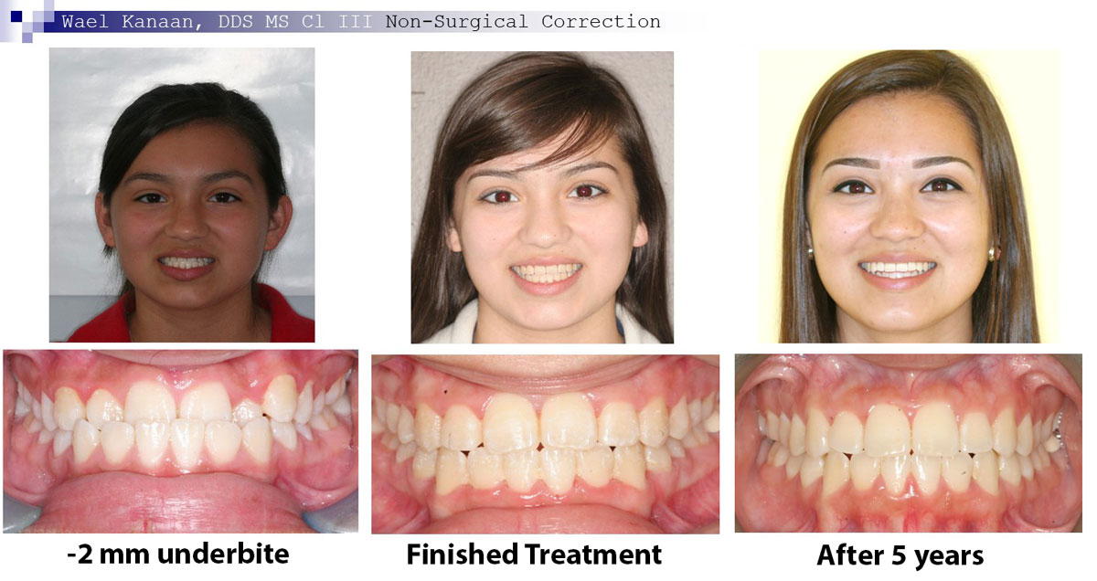 Underbite with stable correction