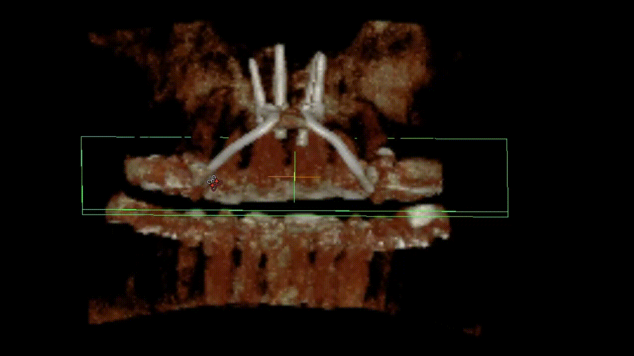 A 3D CT-Scan of a patient's MARPE attached to the roof of the mouth