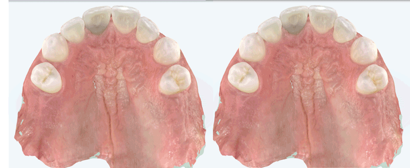 before and after overbite correction in adult