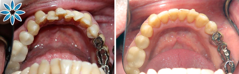 Crooked teeth corrected with Invisalign without extraction