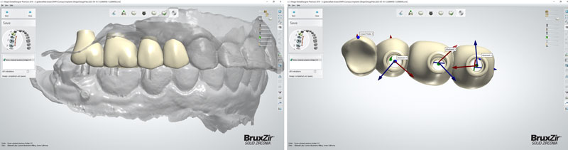 Dental Implant Houston