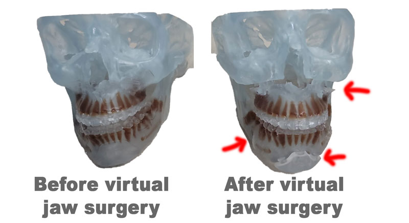 Virtual Orthoognathic Jaw Surgery