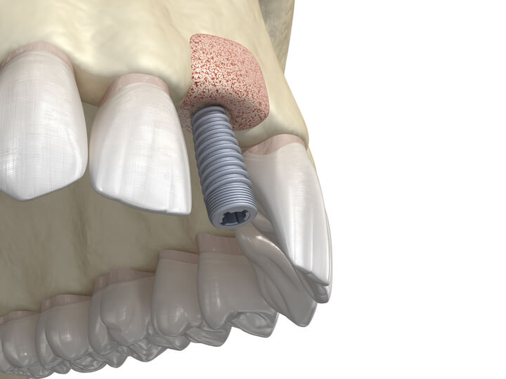 Dental Implant Screws In Bone