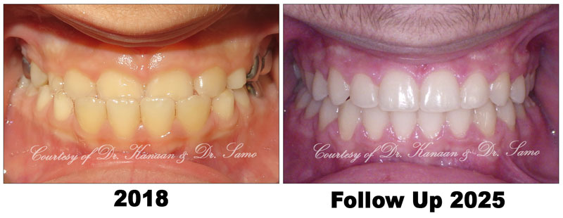 proper age to correct underbite