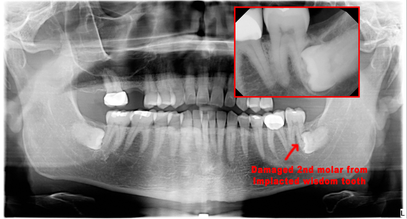 wisdom teeth removal houston