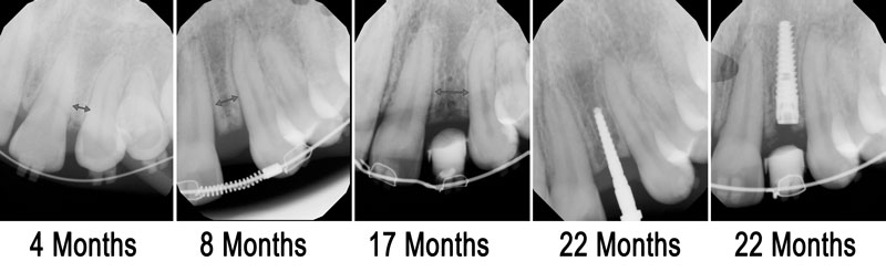 Orthodontic midline correction xray