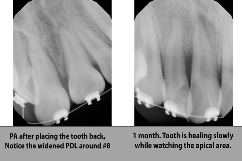 Side-by-side dental X-rays showing the healing progress of a replanted tooth #8, highlighting a widened periodontal ligament (PDL) immediately after placement and the apical area after one month.