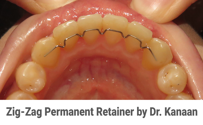 Zig zag permanent retainer