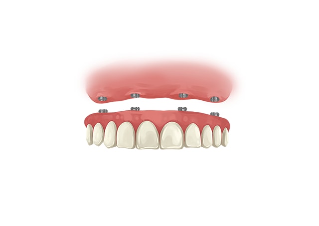 all on 4 dental implants