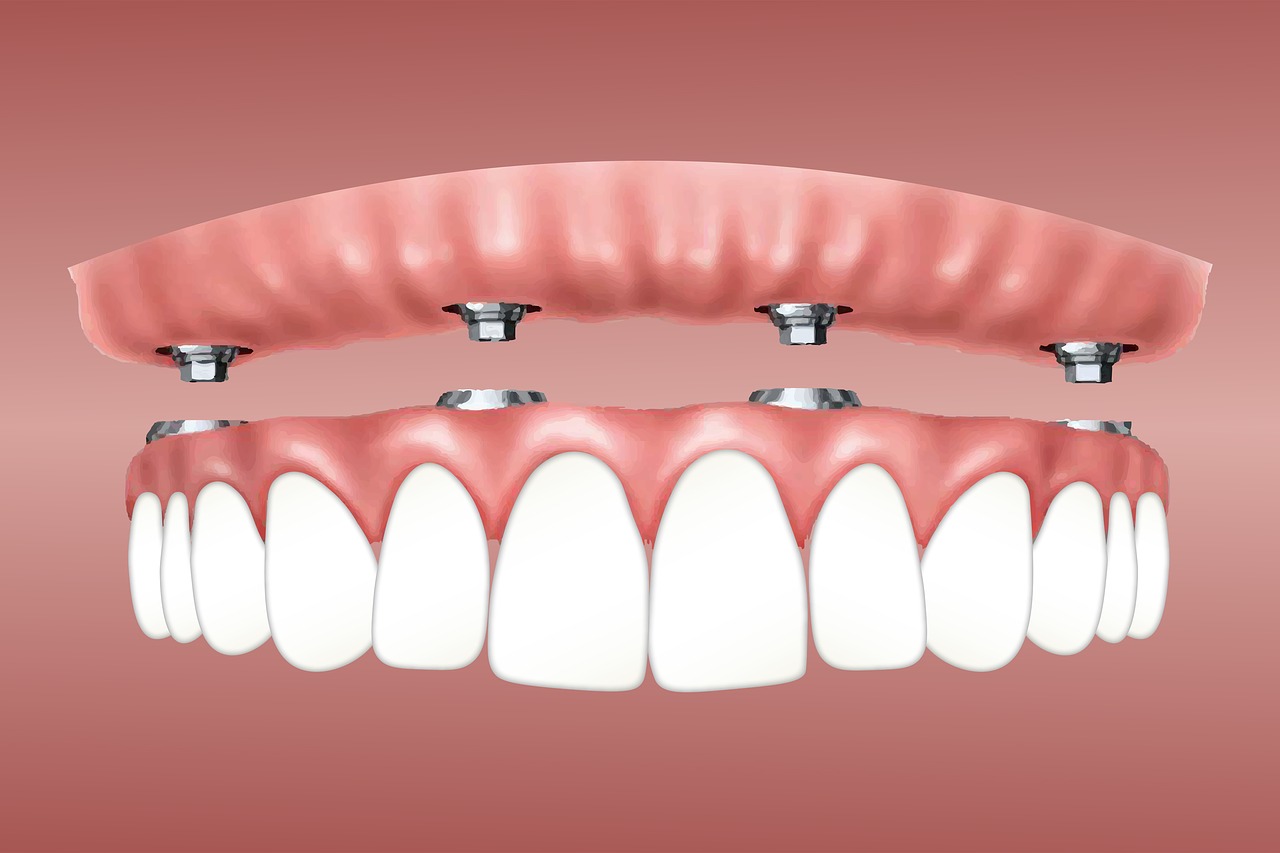 all on 4 dental implants