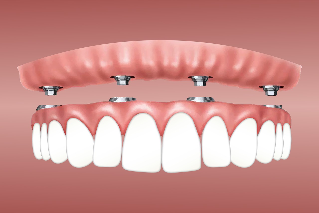 all-on-4 dental implants