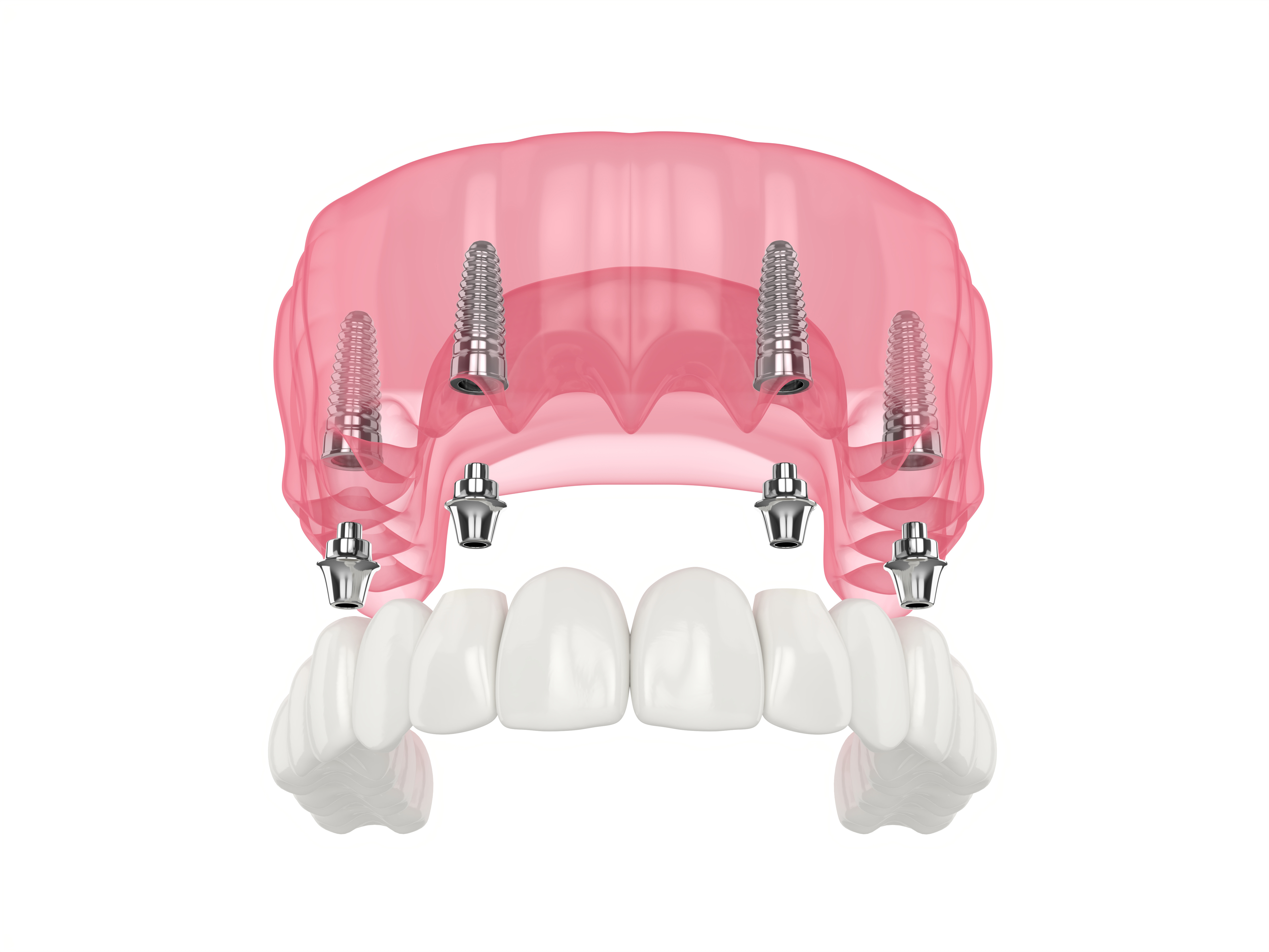 All-on-4 Dental Implants