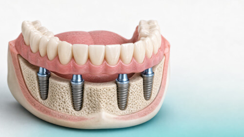 Illustration of a lower full-arch dental restoration supported by four dental implants