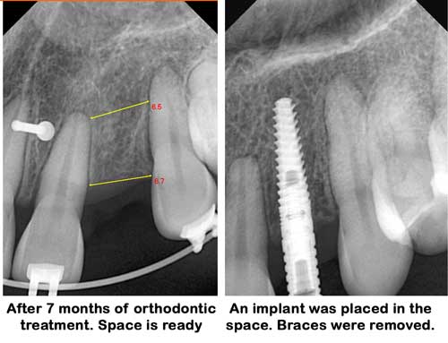 Implant placement with ortho treatment in Sugar Land 