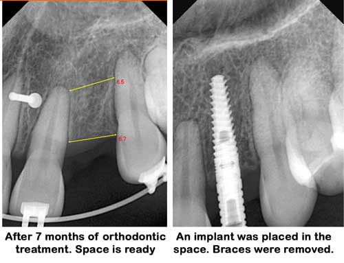Implant placement with ortho treatment in Sugar Land