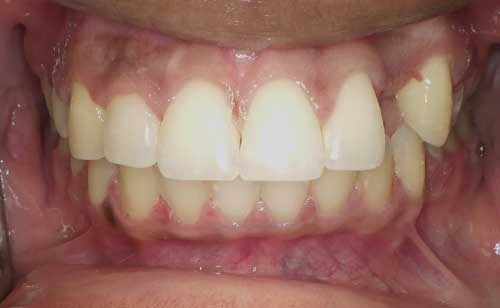 Implant space with ortho treatment in Houston